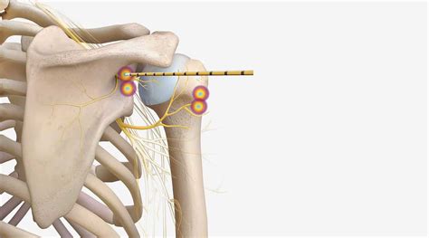 coolief procedure for shoulder pain